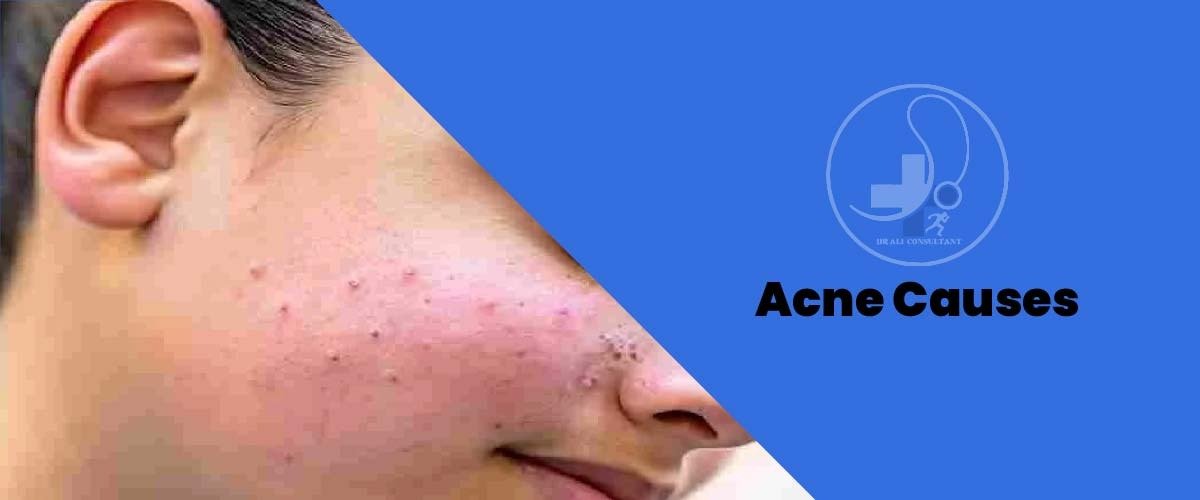 You are currently viewing Acne Causes And Medicine