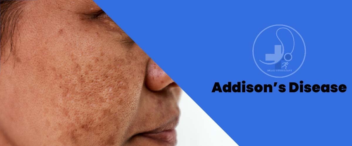 Read more about the article Addison’s Disease Symptoms And Treatment