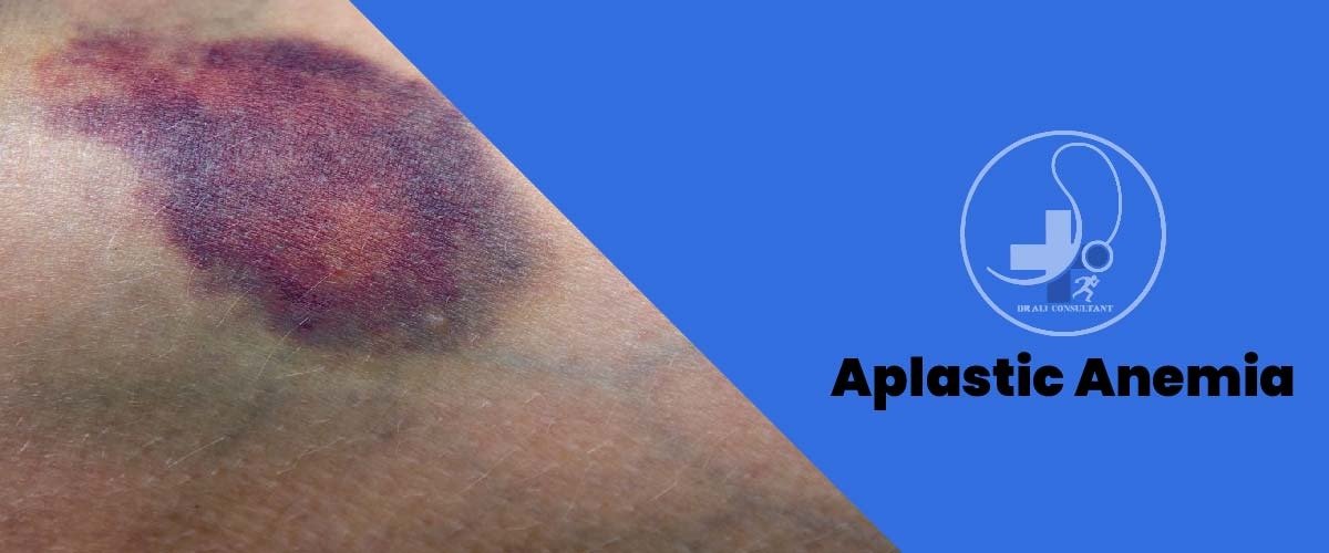Read more about the article Aplastic Anemia