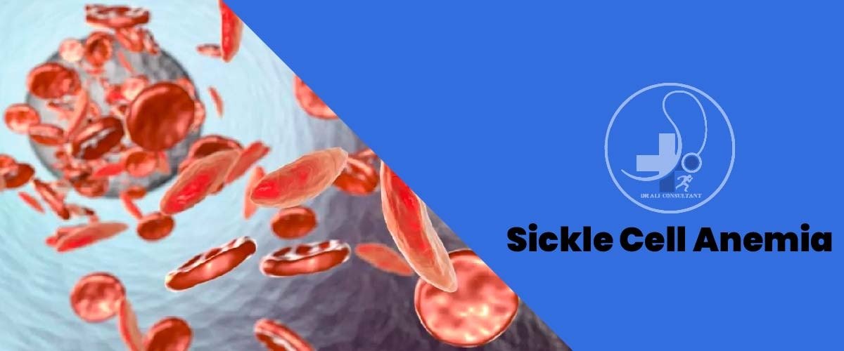 Read more about the article Sickle Cell Anemia