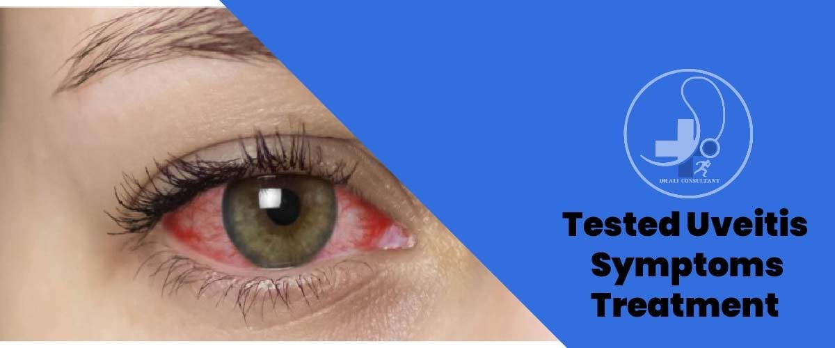 Read more about the article Tested Uveitis Symptoms Treatment