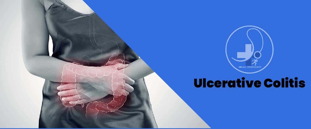 Read more about the article Ulcerative Colitis