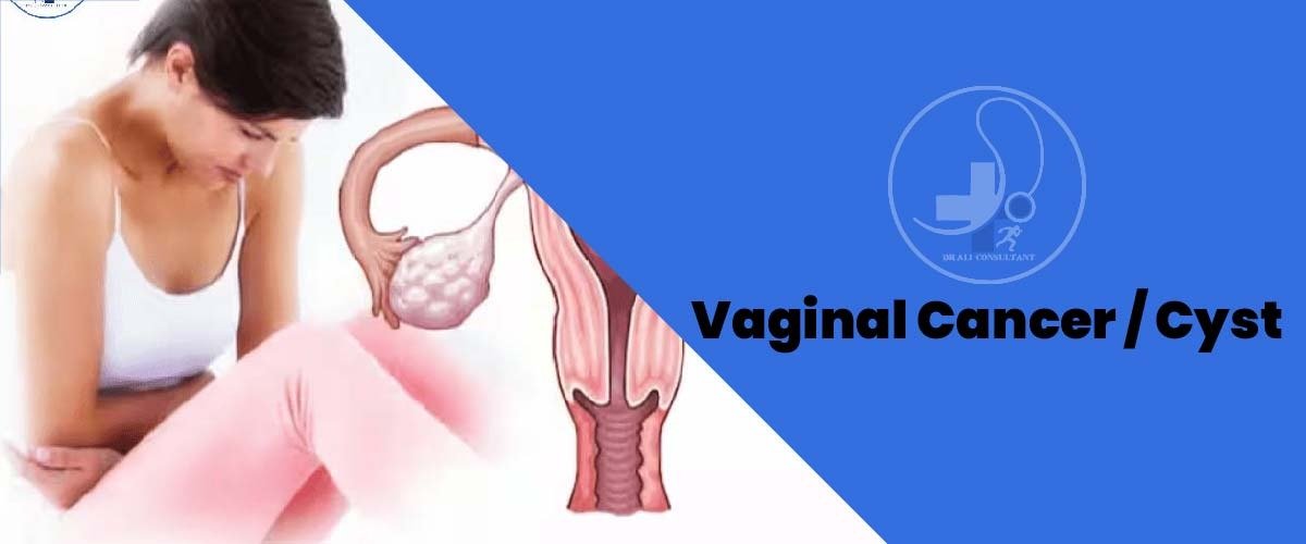 Read more about the article Vaginal Cancer/ Cyst Symptoms and Treatment