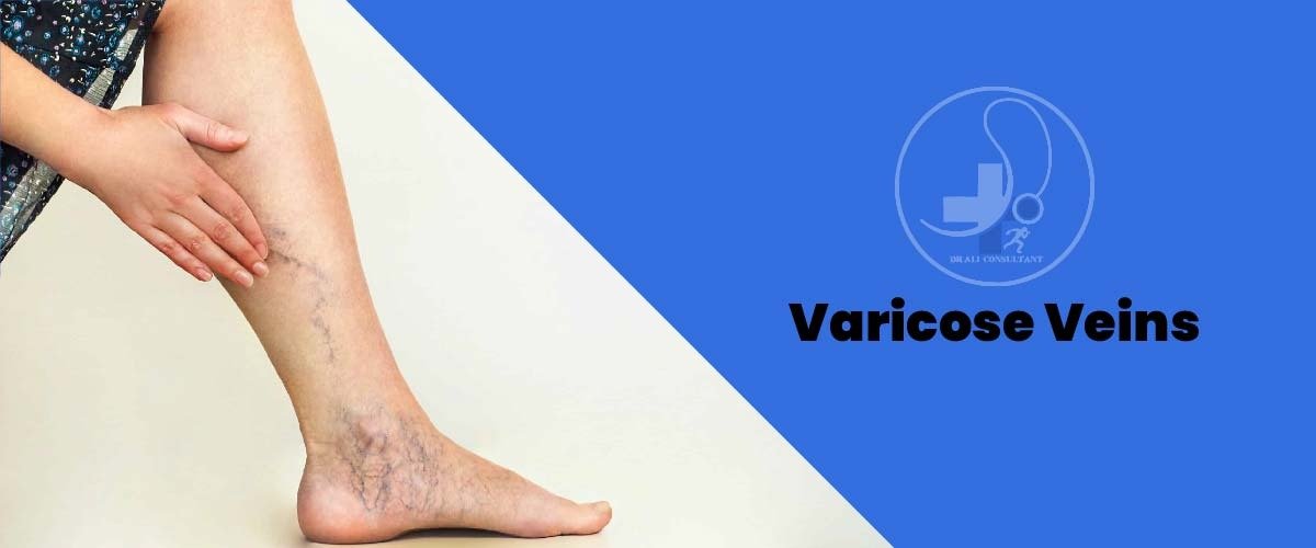 You are currently viewing Varicose Veins Symptoms And Treatment