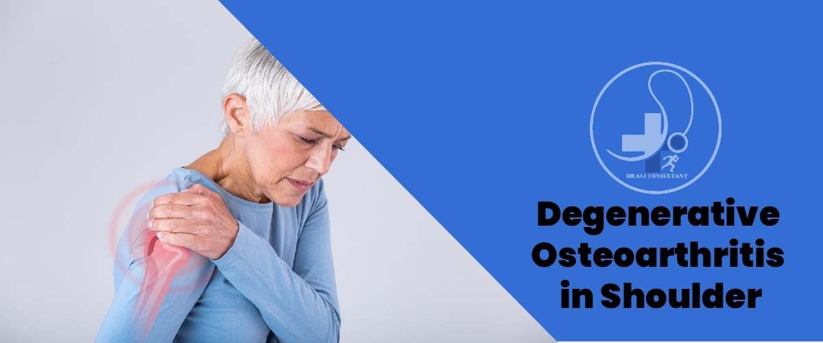 Read more about the article Degenerative Osteoarthritis in Shoulder