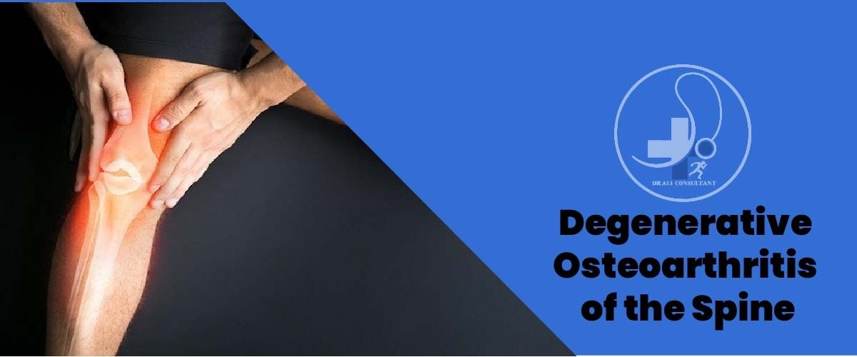 Read more about the article Degenerative osteoarthritis knee