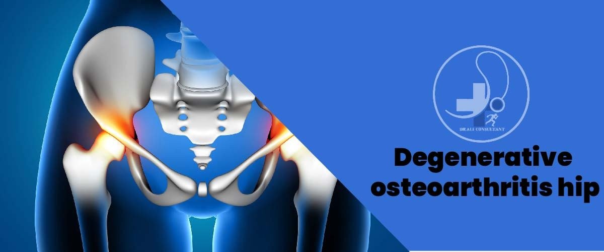 Read more about the article Degenerative osteoarthritis hip