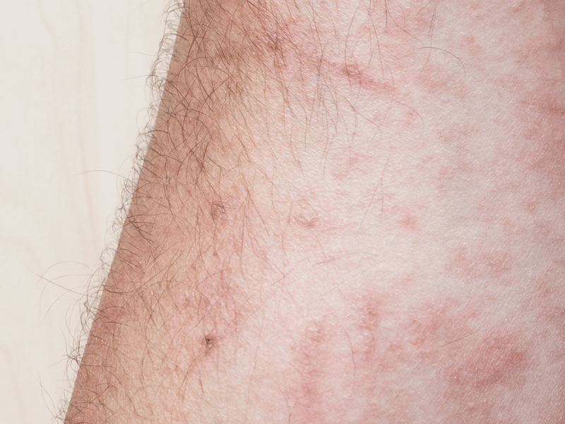 Read more about the article Scleroderma & Dermatomyositis: Symptoms , Causes and Dermatology Insights on Autoimmune Diseases