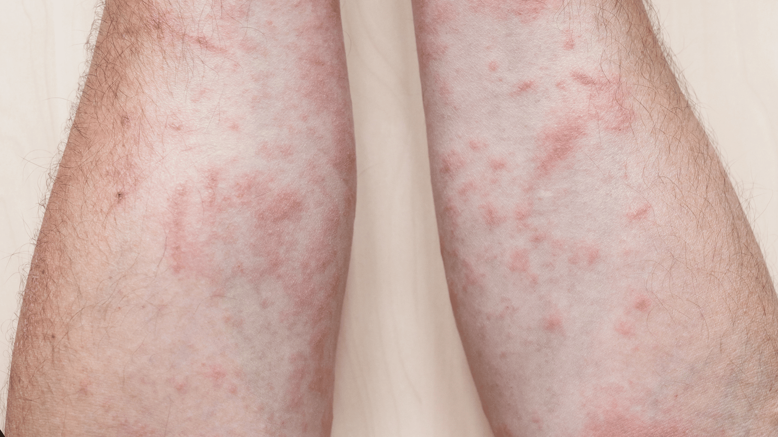 chronic autoimmune skin disorders