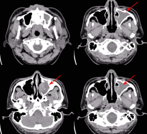 Read more about the article Chronic Sinusitis: The Role of Sinus Computed Tomography