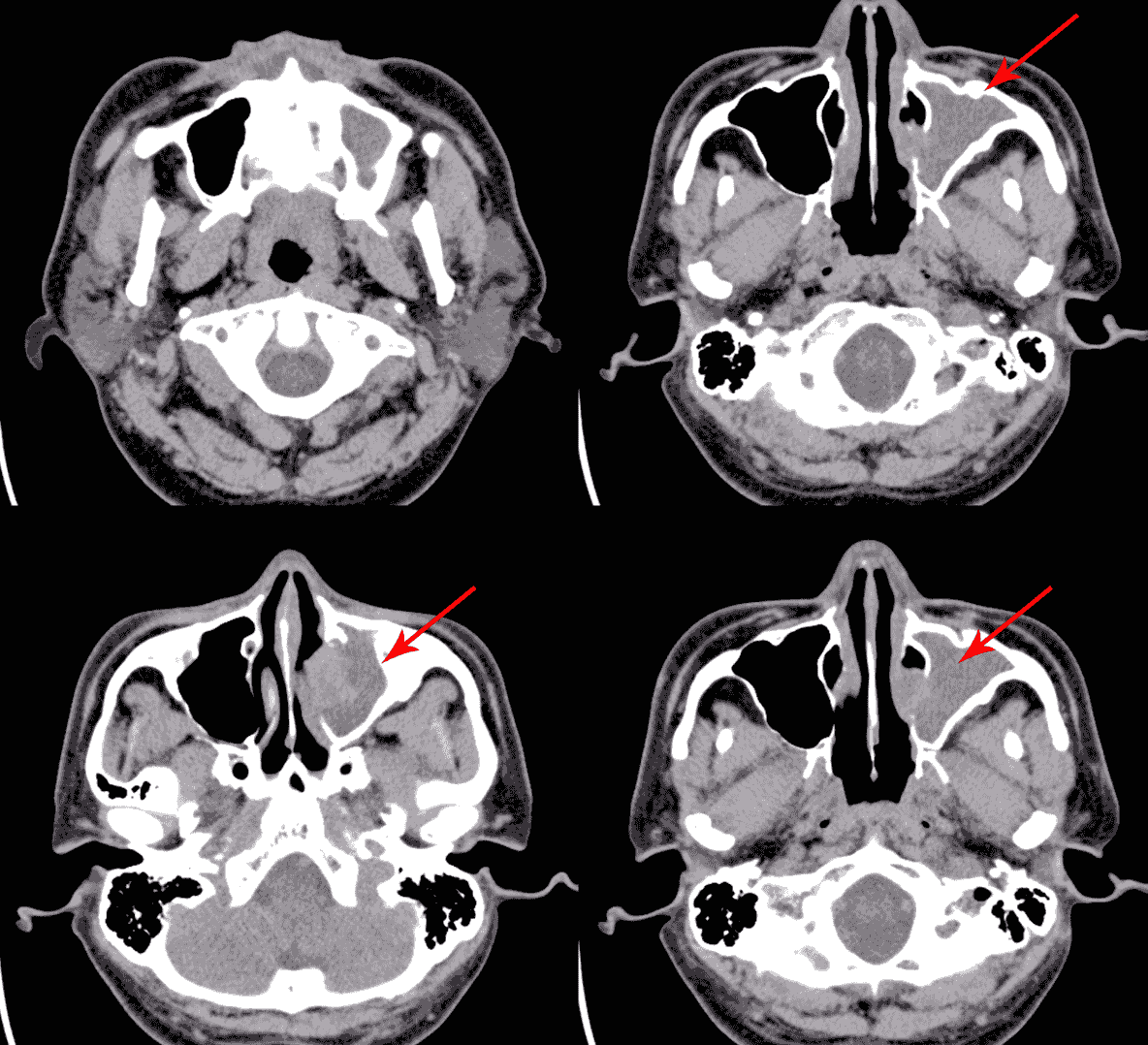 Chronic Sinusitis: The Role of Sinus Computed Tomography Sinusitis