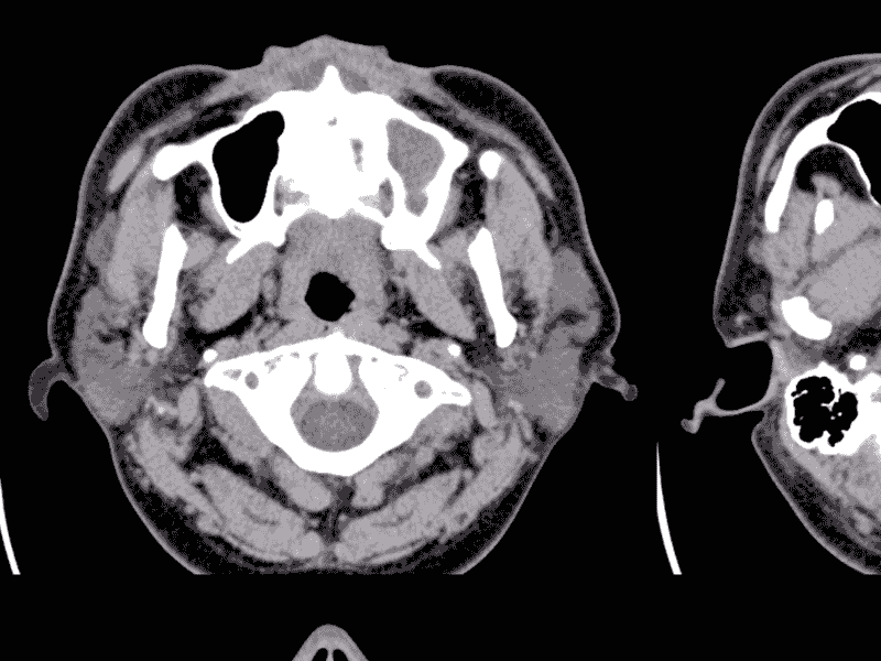 Read more about the article Chronic Sinusitis: The Role of Sinus Computed Tomography