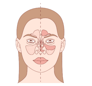 Chronic Sinusitis: The Role of Sinus Computed Tomography Sinusitis