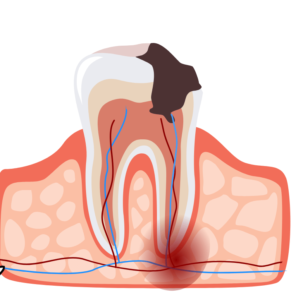 Apical Periodontitis