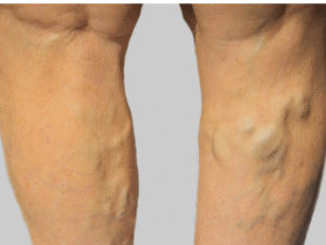 Read more about the article Chronic Deep Vein Thrombosis (DVT): Blood Clot and Vein Care