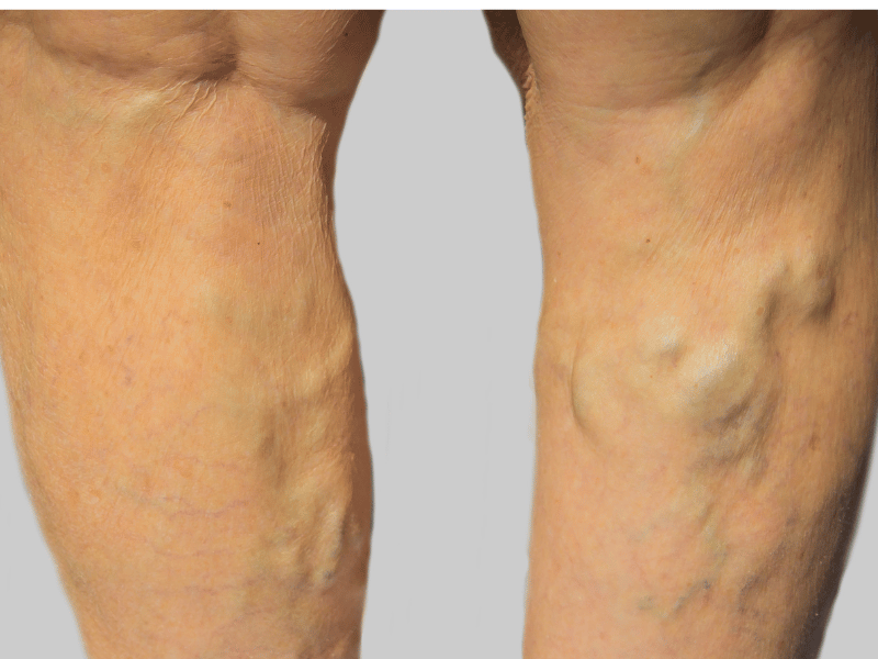 Read more about the article Chronic Deep Vein Thrombosis (DVT): Blood Clot and Vein Care