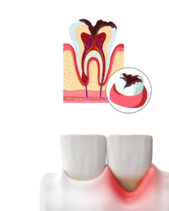 Swelling of the gums and periodontium tooth