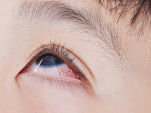 Read more about the article Red Eye vs Chronic Red Eye: Causes and Symptoms