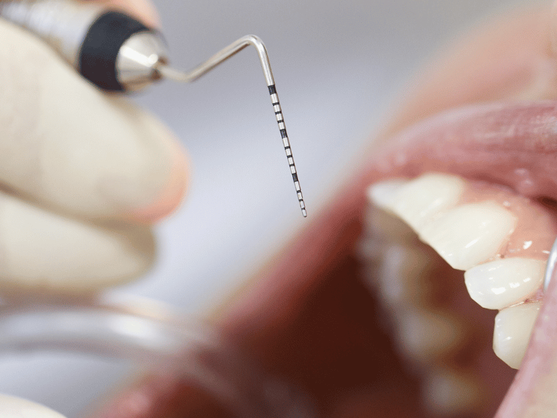 Read more about the article What is Chronic Apical Periodontitis: Causes, Symptoms, and Treatments