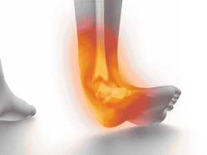 Read more about the article Chronic Anterior Talofibular Ligament Tear Treatment