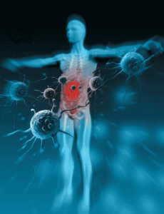 Read more about the article Chronic Radiation Proctitis: Causes, Symptoms, Diagnosis, and Effective Treatments