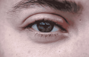 Read more about the article Styes on the Eyelid: Causes & Treatment