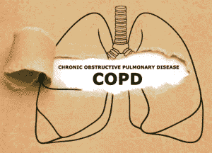 Read more about the article Chronic Obstructive Pulmonary Disease (COPD): Management & Breakthrough Therapies