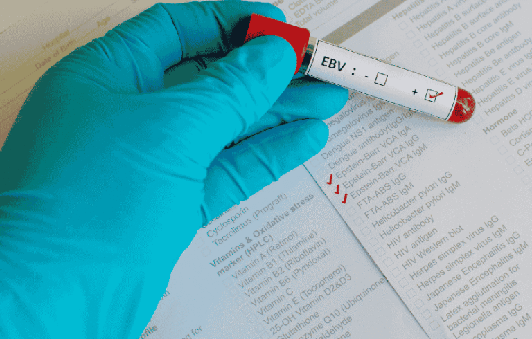Chronic EBV (Epstein-Barr Virus) Symptoms, Causes , and Treatment