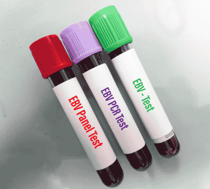 chronic EBV