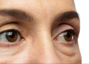 Chronic Eye Swelling: The Real Reasons Behind Persistent Puffiness and How to Treat It